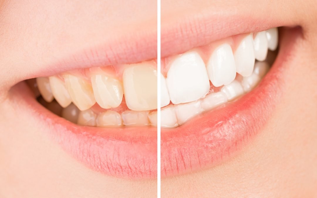 Lifestyle Adjustment After Dentures
