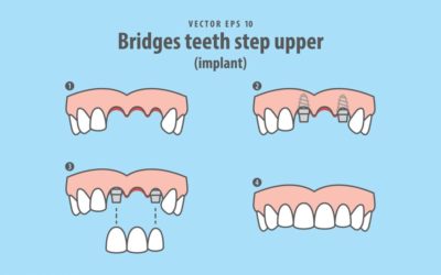 Glossary of Dental Implants Dentistry
