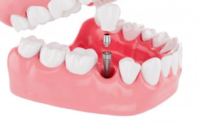 Fixed Denture Implants – What You Need To Know