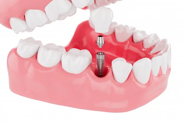 Fixed Denture Implants – What You Need To Know