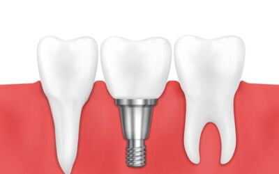 Everything You Need To Know About Denture Implants