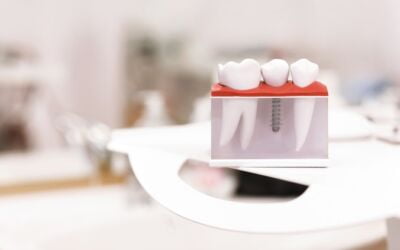 Mini Dental Implants and Why They’re So Popular