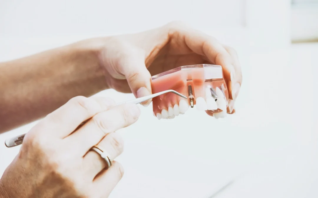 Caring For Your New Teeth After Denture Implant Surgery