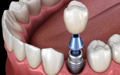 Are Implant Retained Dentures Right for You?