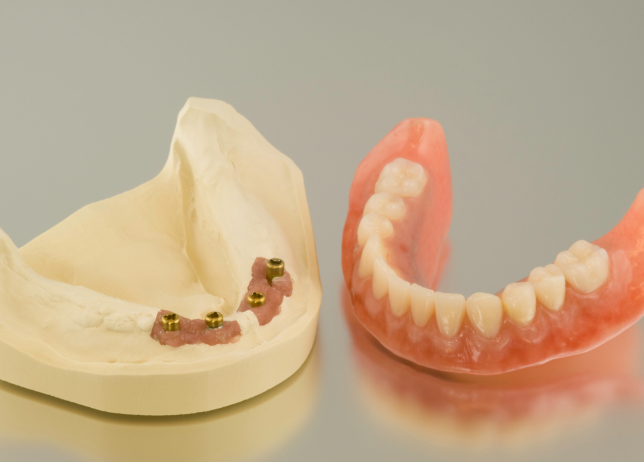 Why You Should Get Implant Dentures